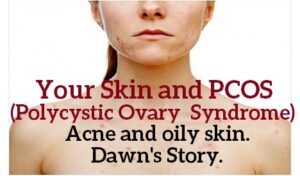 Your Skin and PCOS (Polycystic Ovary Syndrome) Acne and oily skin. Dawn’s story